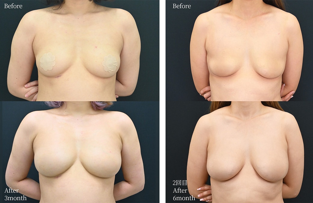 30代 脂肪注入豊胸