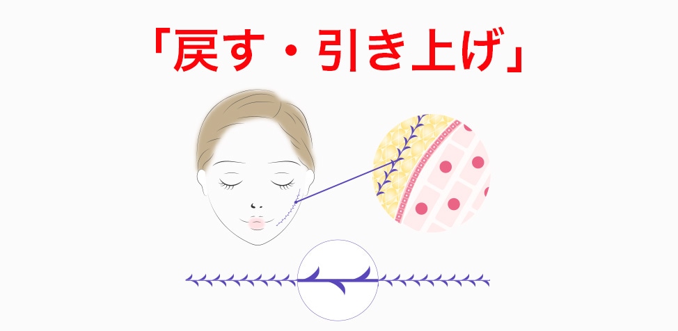 糸リフトの役割