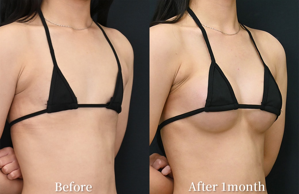 20代 シリコンバッグ豊胸