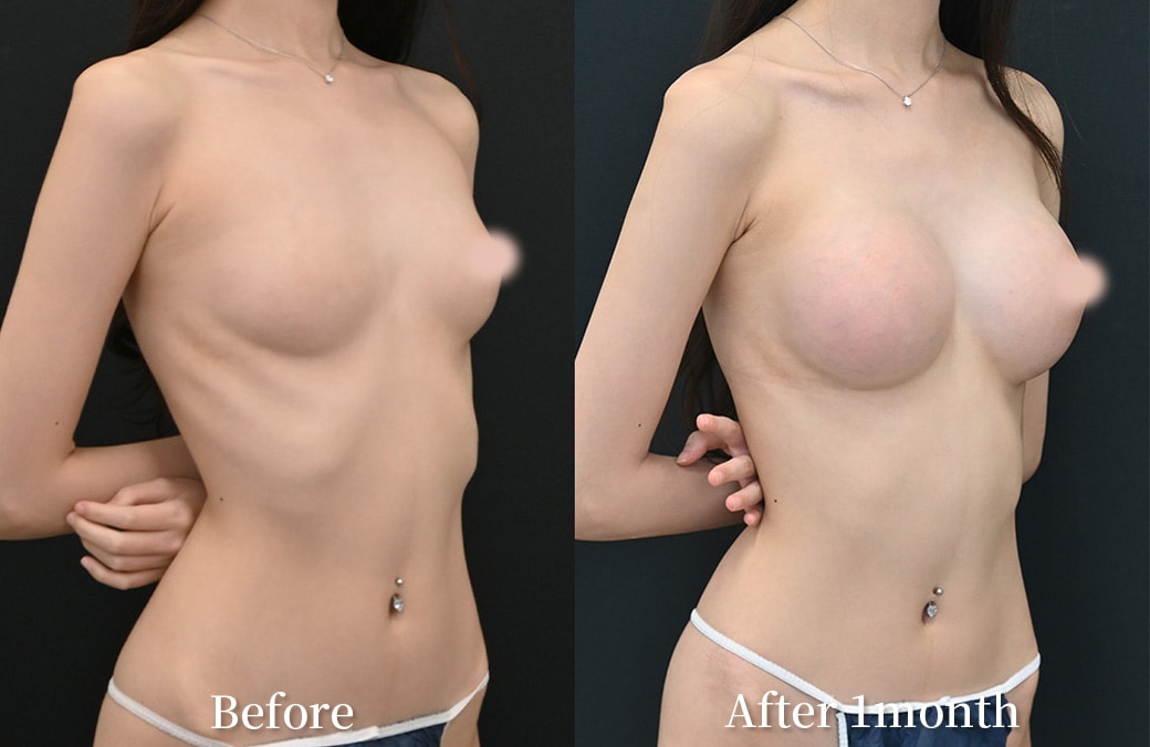 10代 シリコンバッグ豊胸