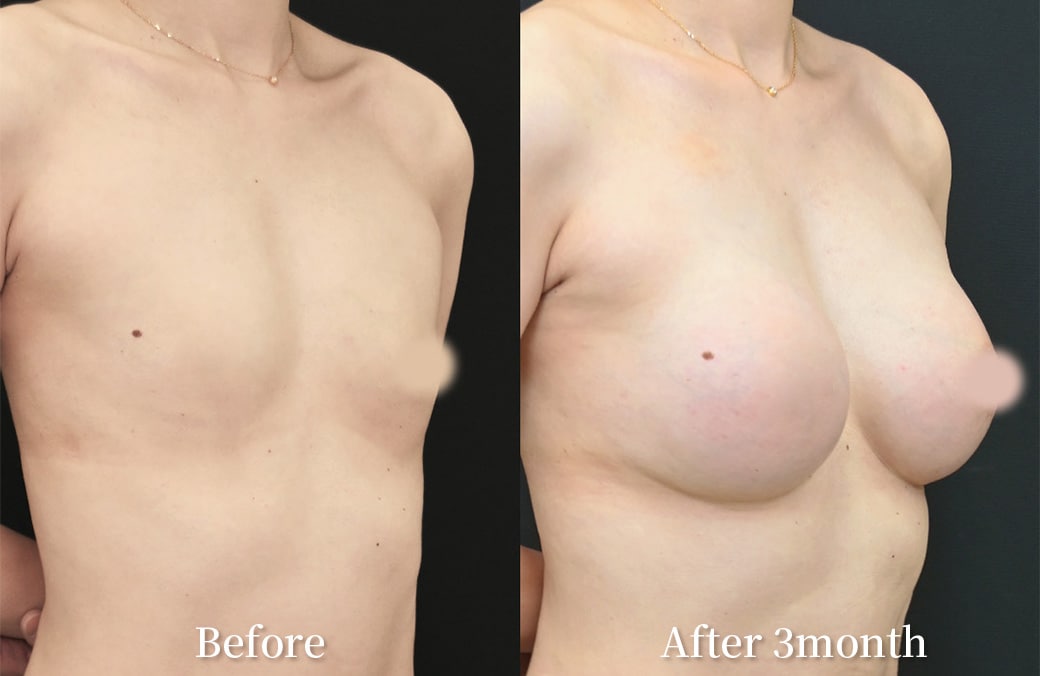 40代 ハイブリッド豊胸