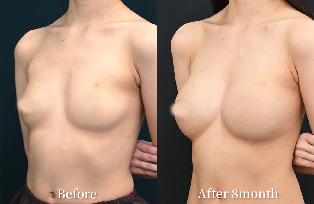 20代 ハイブリッド豊胸