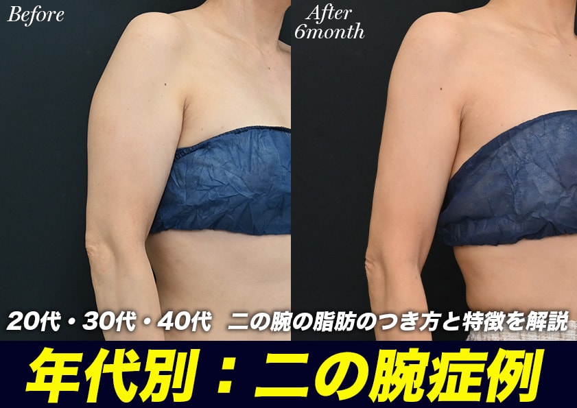 【二の腕脂肪吸引の名医】年代別に二の腕の脂肪のつき方と特徴を解説！湘南美容クリニック名古屋院