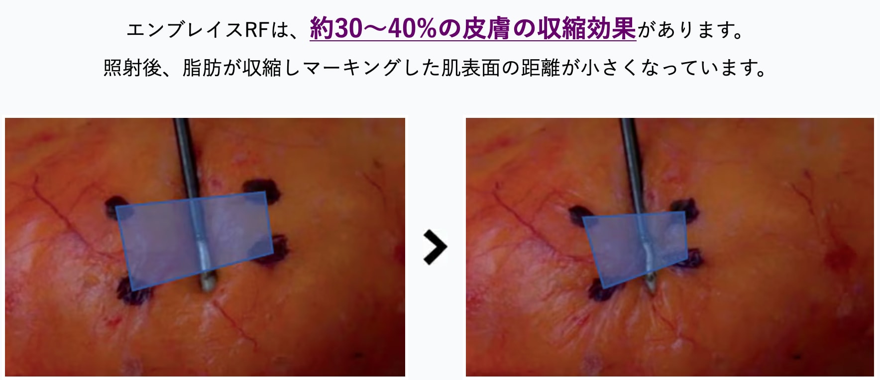 エンブレイスRFとは？皮膚を引き締める最新技術