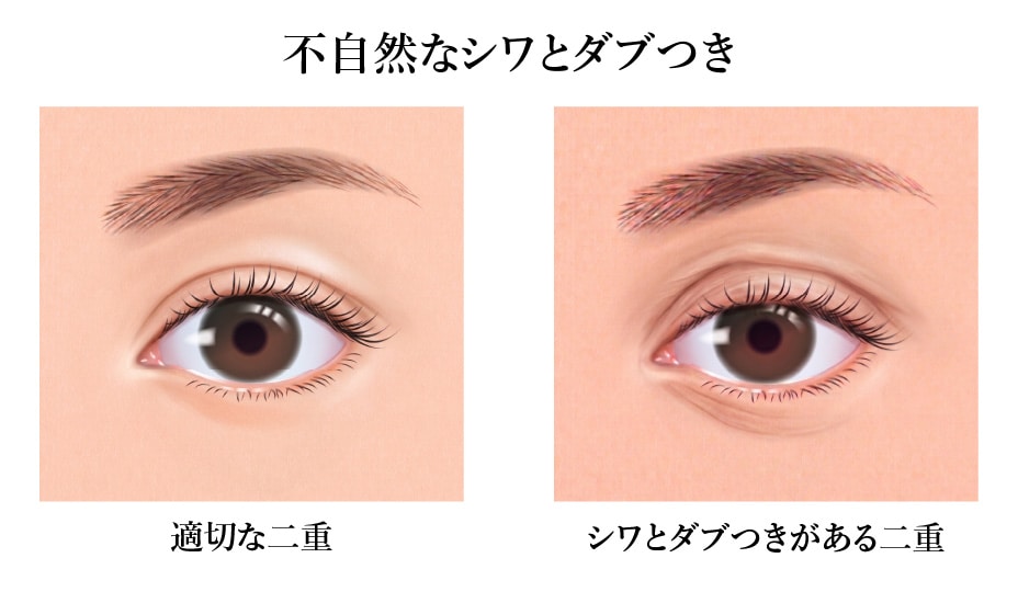 原因②：まぶたの余った皮膚が引き起こす「不自然なシワとダブつき」