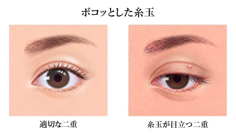 原因③：至近距離や伏し目でバレる「ボコッとした糸玉」