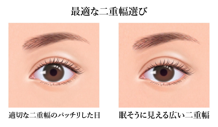 原因①：幅を広げすぎることによる「黒目の露出低下（眠そうな目）」