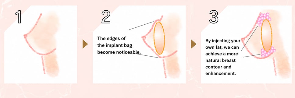 Hybrid breast augmentation