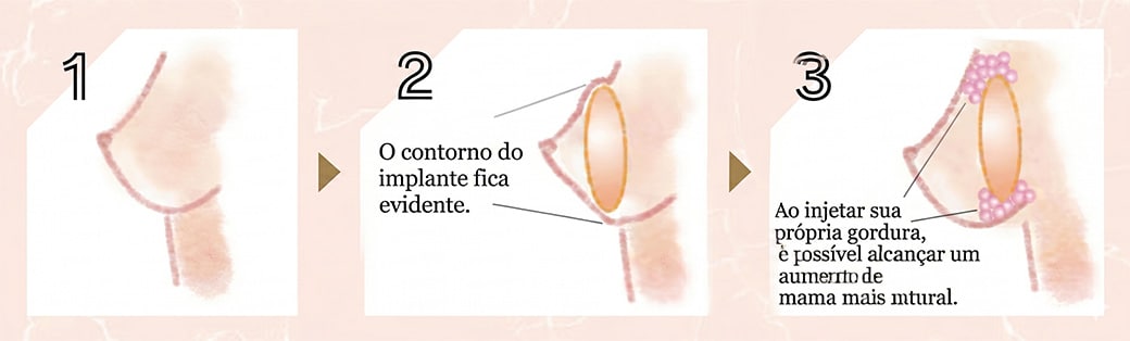 Aumento mamário híbrido