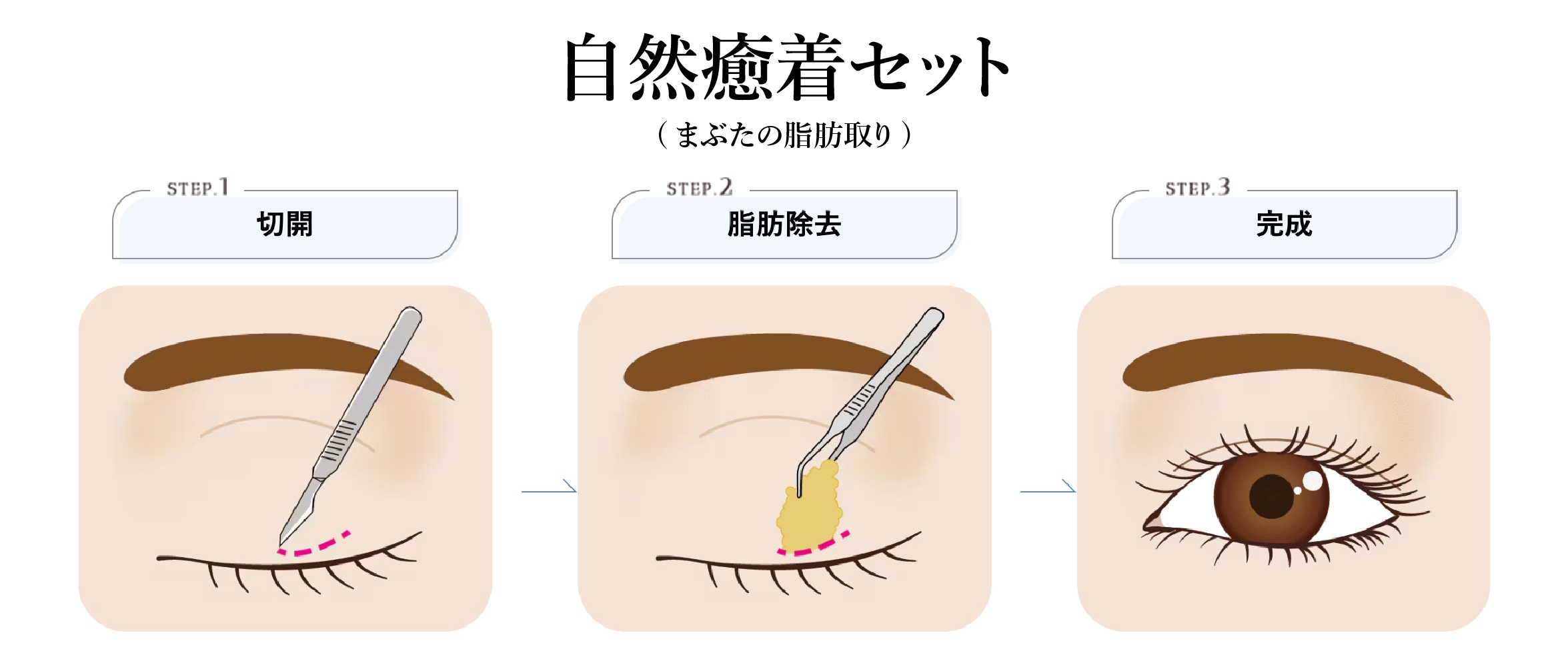 二重埋没法 + まぶたの脂肪取り(自然癒着法)