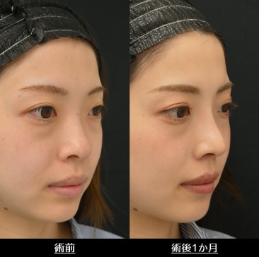 プロテーゼ/鼻尖形成３D法/鼻尖部軟骨移植