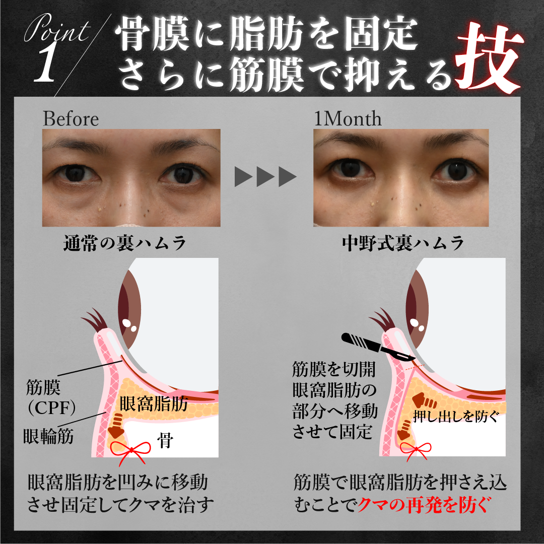 再発防止に特化した中野式裏ハムラ法