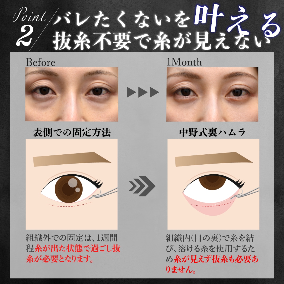 ②脂肪の固定は組織内で
