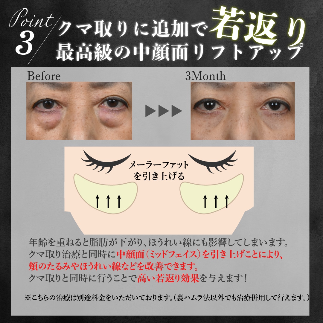 ②中顔面を引き上げより高い若返り効果を