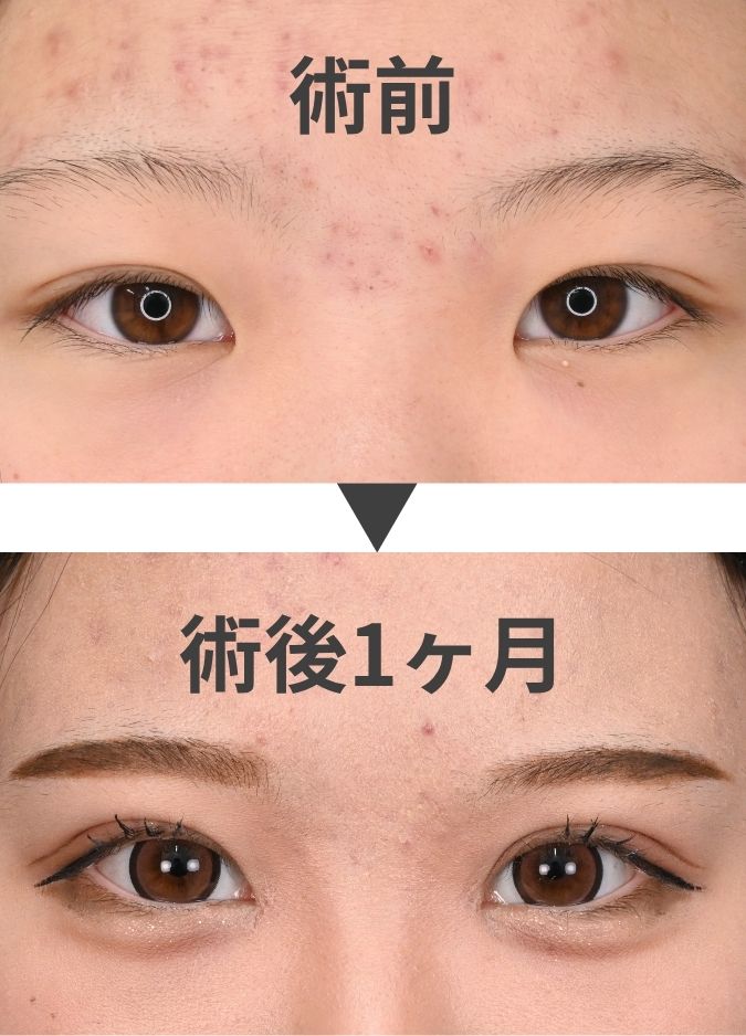 目頭切開とは
