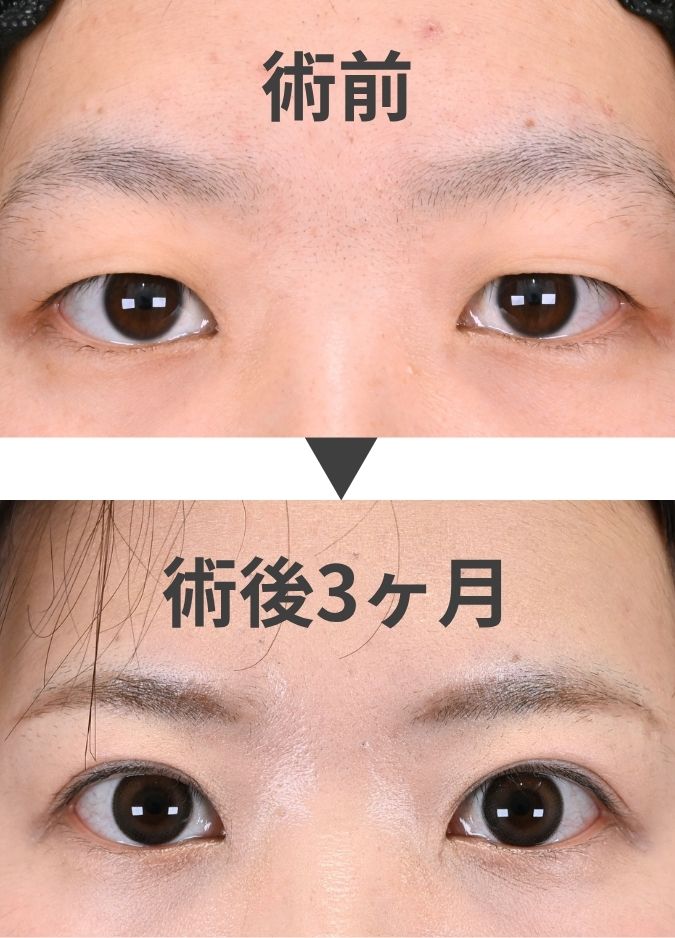 タルミ取り併用全切開法二重術とは