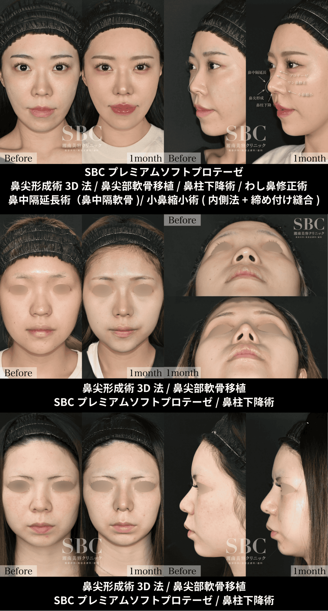 鼻の整形手術が下手