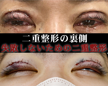二重整形で失敗しないための完全ガイド！知らないと後悔する重要ポイント解説