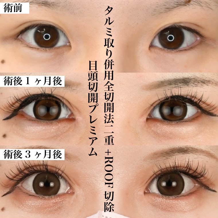 中野流半永久の切開二重術
