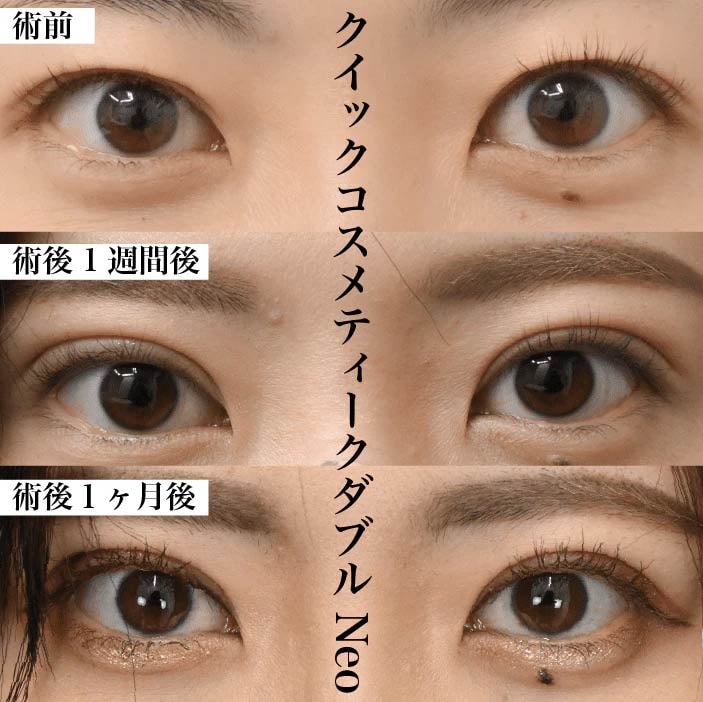 中野流ナチュラルな瞳の埋没二重術