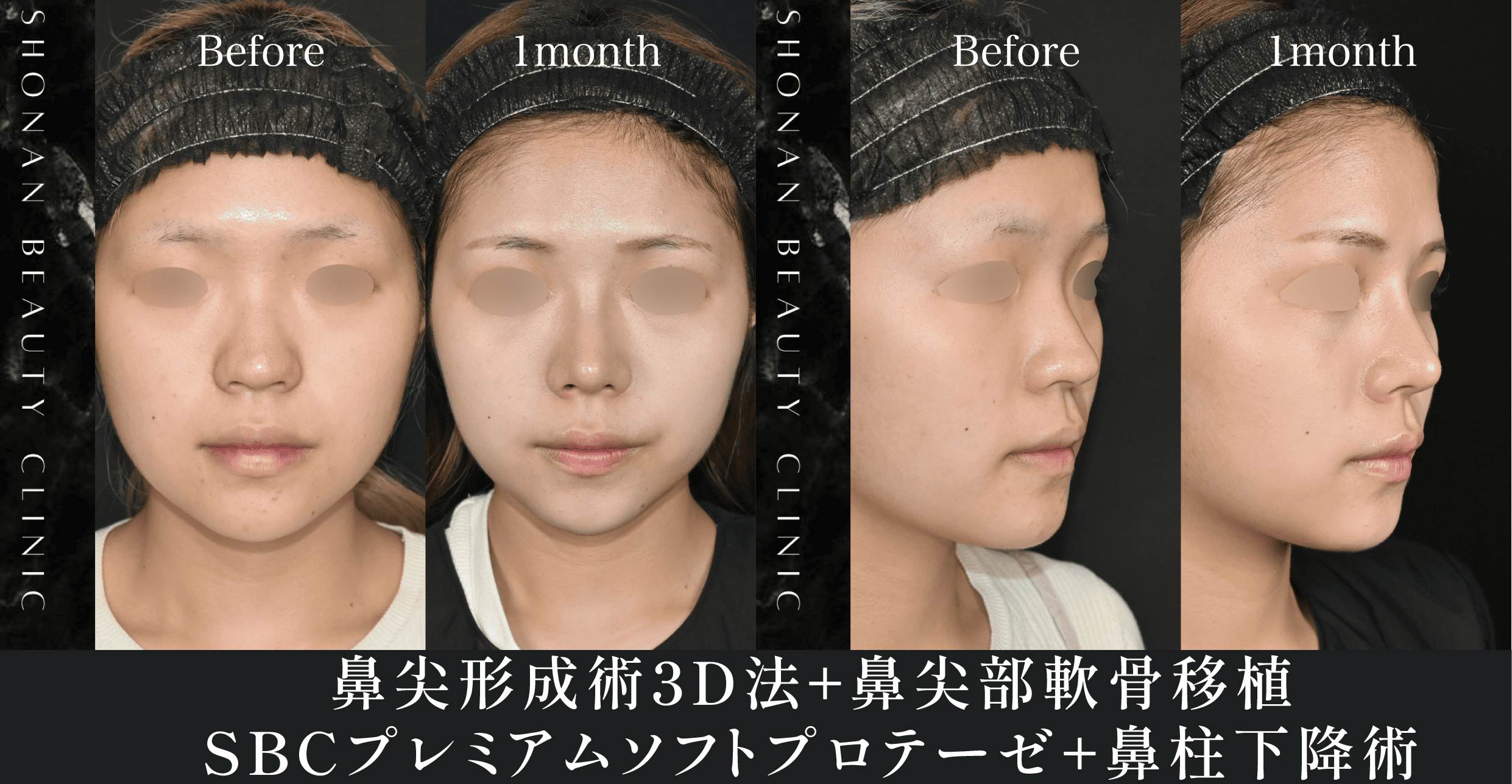 鼻の穴が見える　av女優 忘れ鼻とはどんな鼻？令和美人の条件と言われる忘れ鼻を解説！最新の鼻整形の魅力を大公開!! - 名古屋栄院