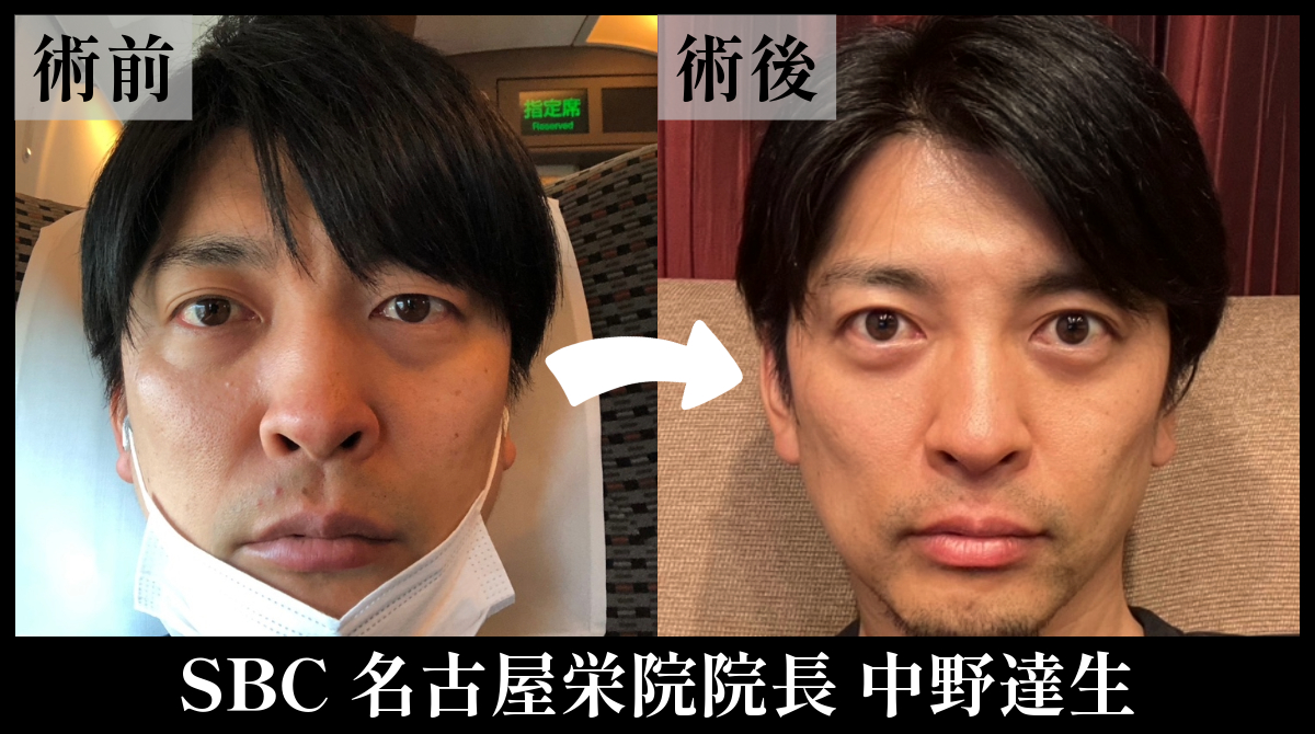 【男性必見！】疲れ顔＆老け顔を解消するメンズクマ取り！おすすめの理由を徹底解説します！