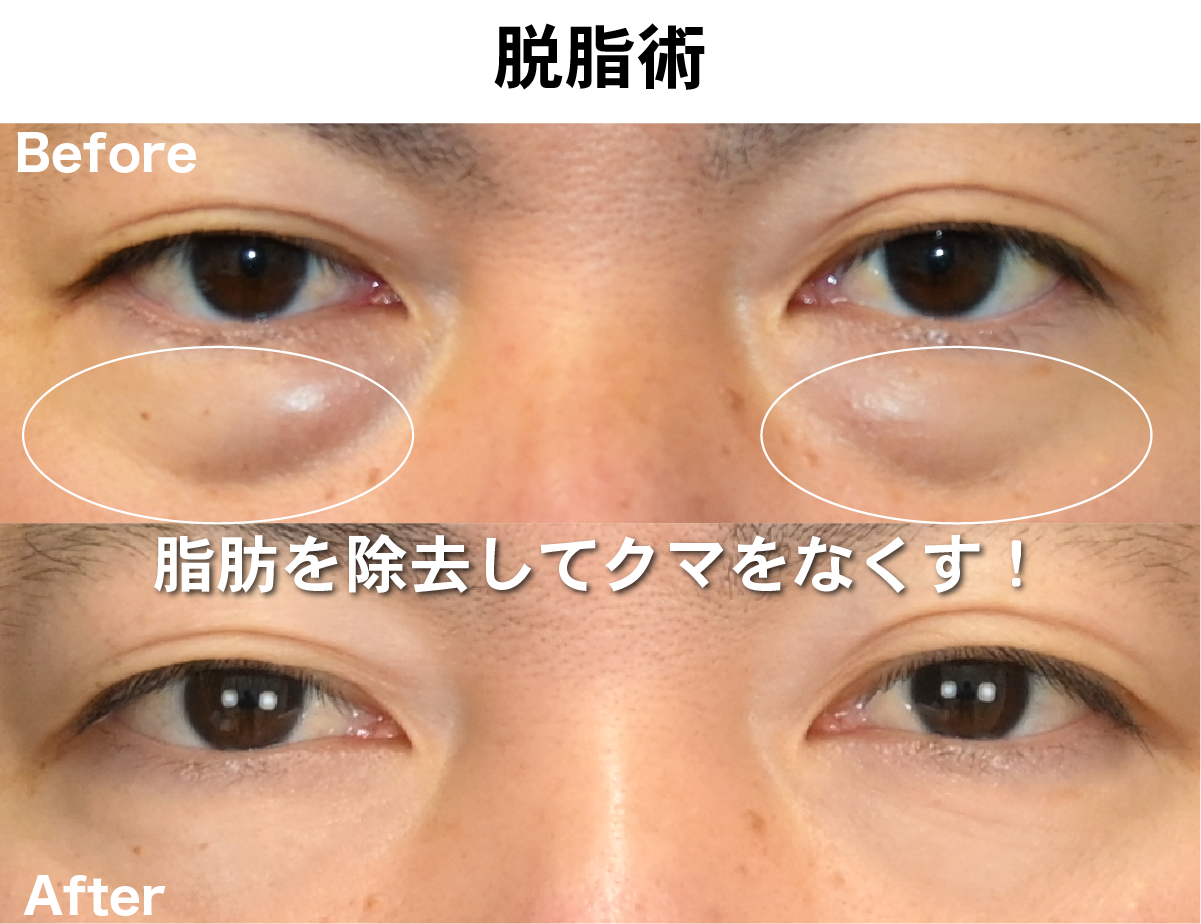 経結膜脱脂法(目の下の切らないクマ取り)