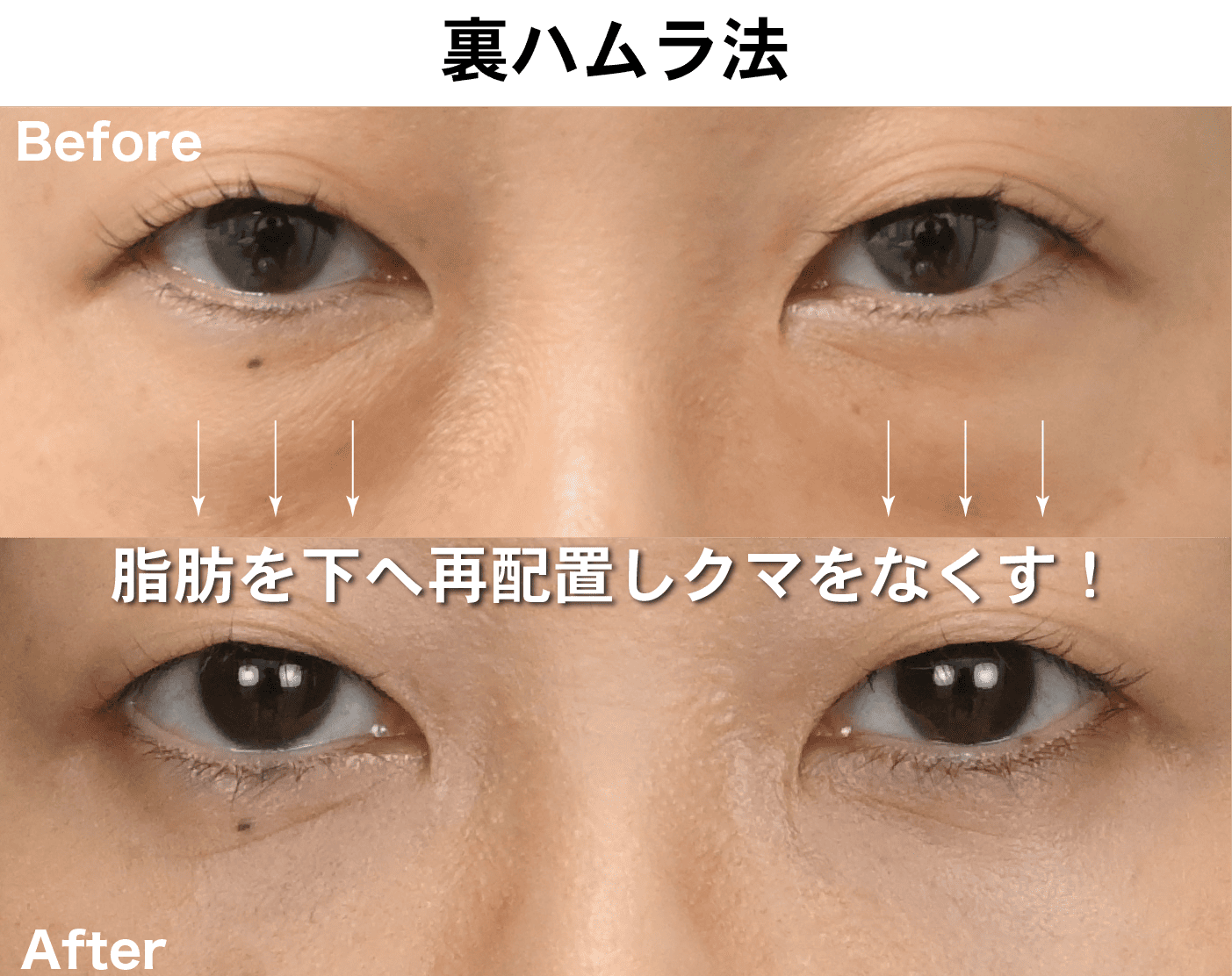 裏ハムラ法(経結膜ハムラ法)