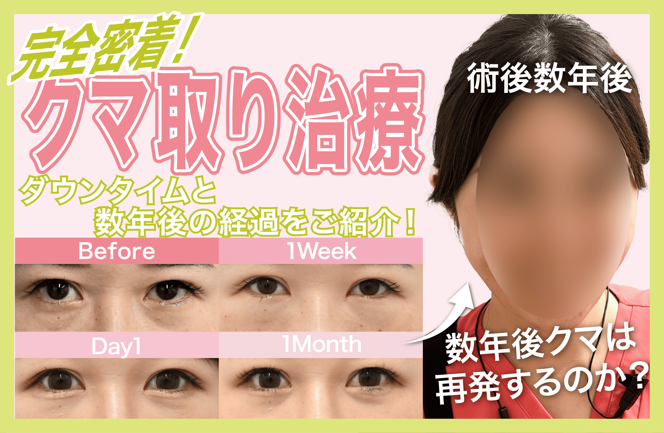 目の下のクマ取りの経過を数年後まで徹底解説！再発防止特化医師のクマ取りは本当に再発しないのか？ - 名古屋栄院, image size:2258x1473