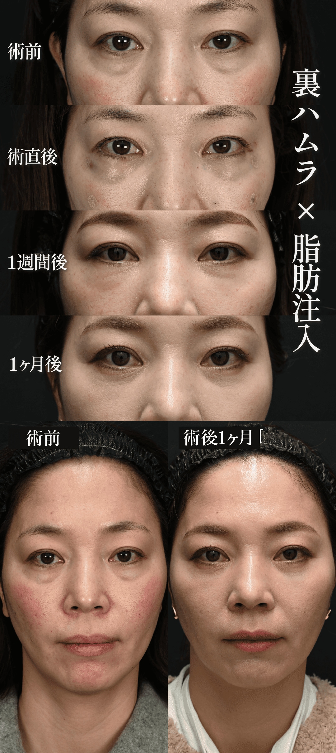 中野医師による裏ハムラ法症例