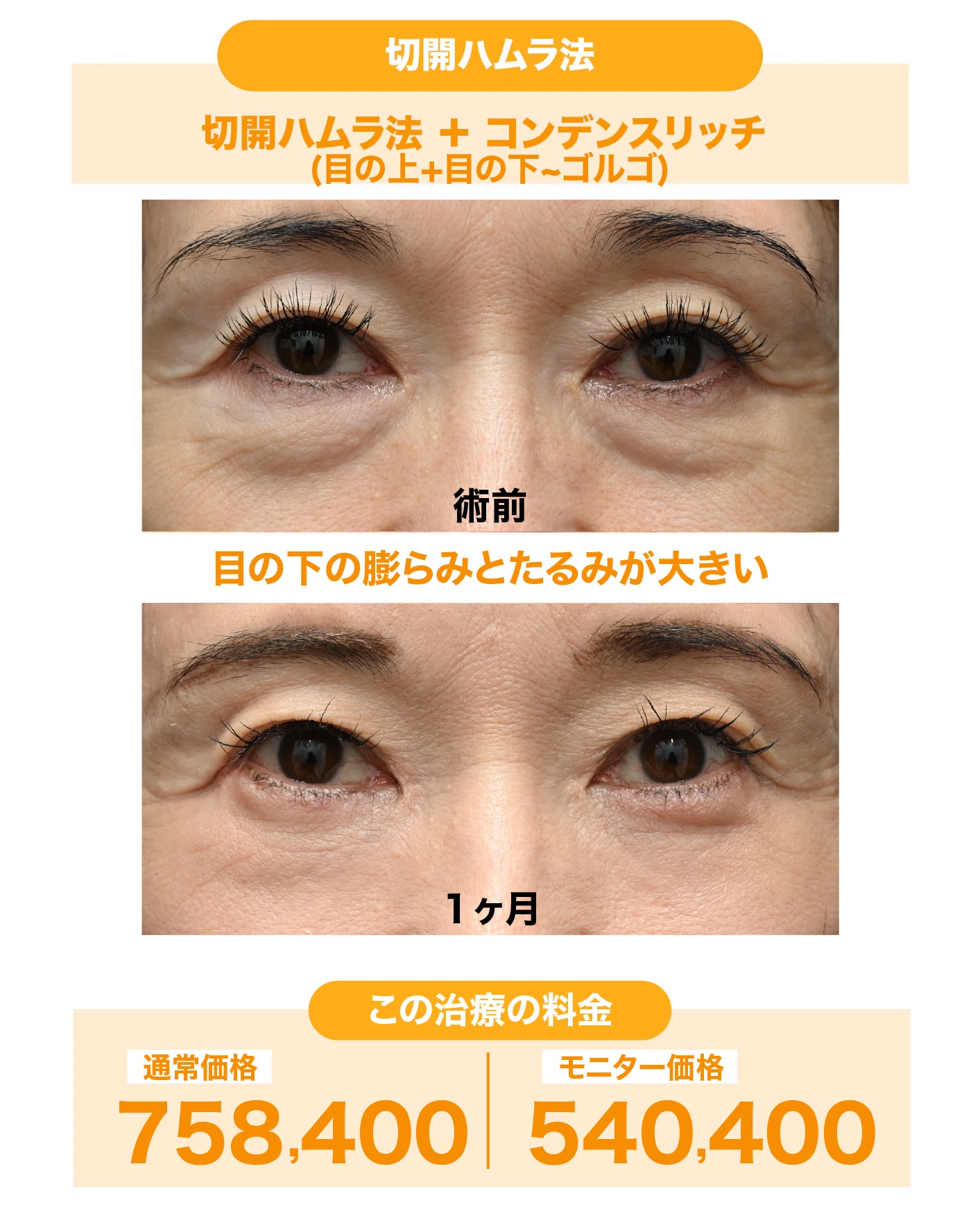 60代女性:切開ハムラ法＋ナチュラル脂肪注射（コンデンスリッチ）