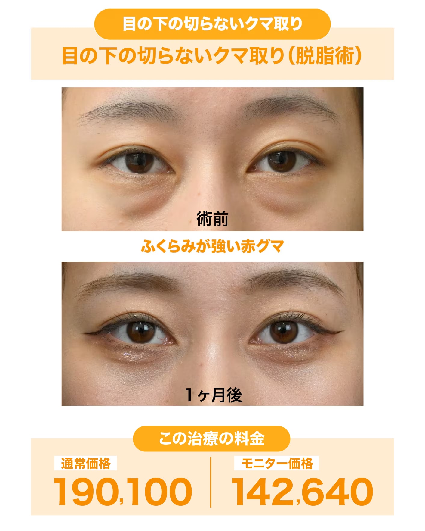 20代女性:目の下の切らないクマ取り(脱脂術)