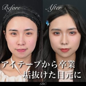 二重症例