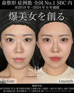 鼻症例