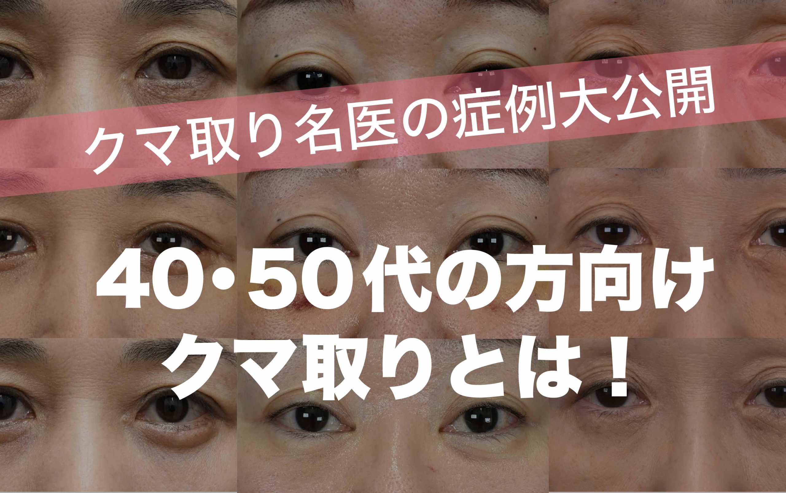 【症例公開】40〜50代の方向けクマ取り！！全国No.1のクマ取り名医が行った症例を施術別でご紹介