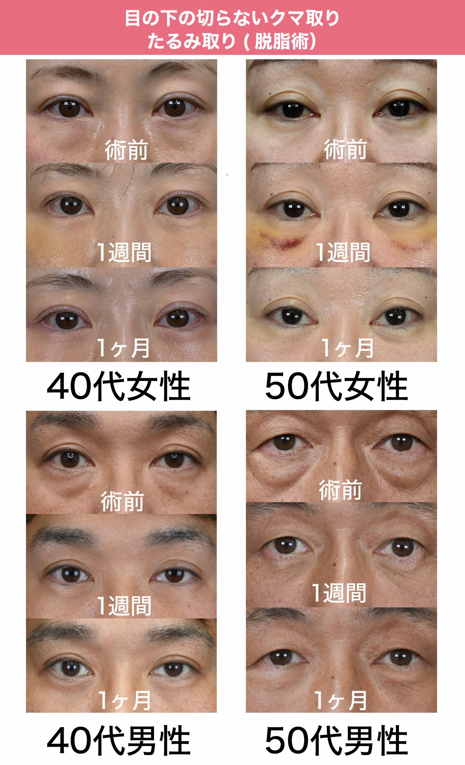 【目の下の切らないクマ取り・たるみ取り(脱脂術）】症例紹介