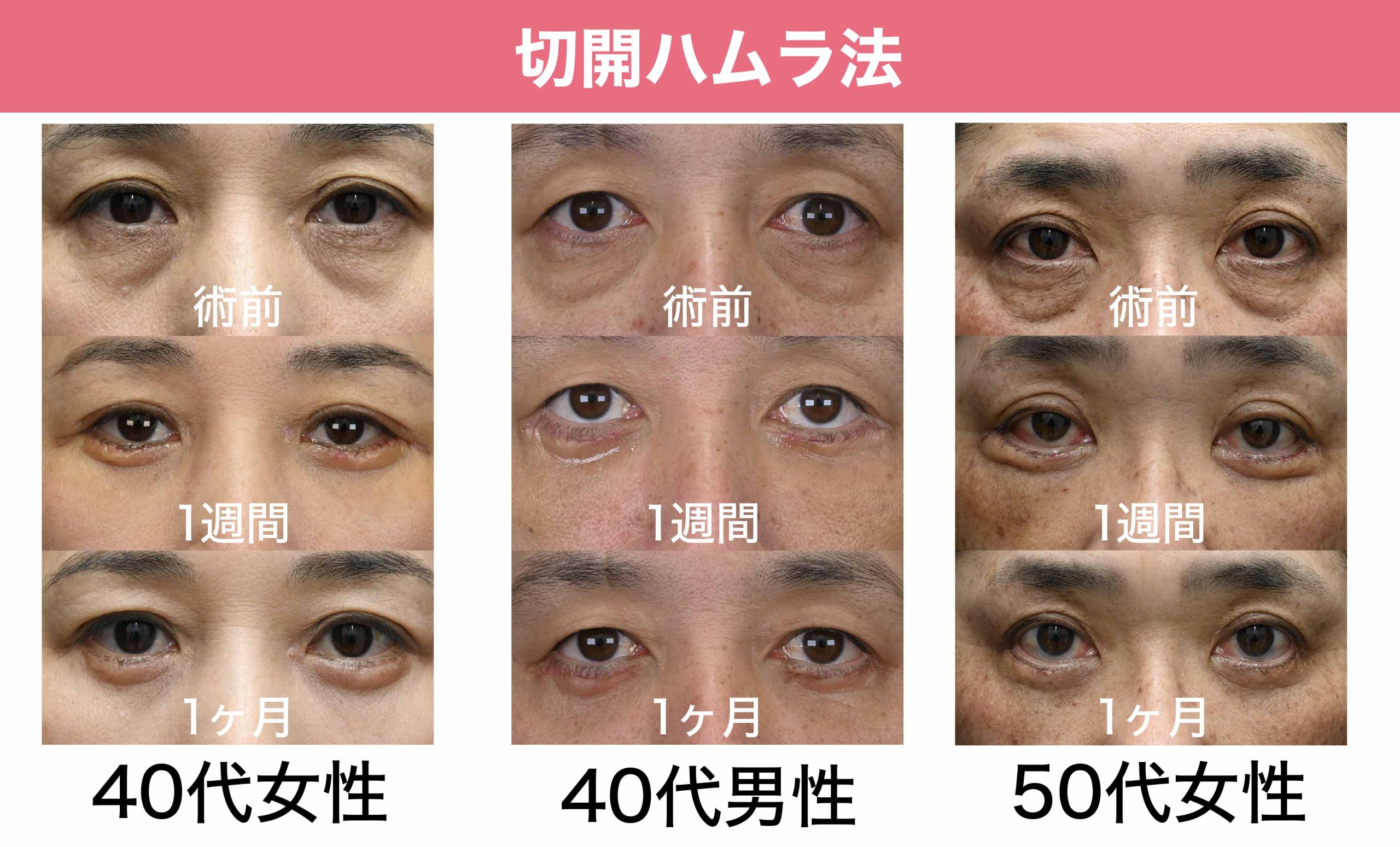 【切開ハムラ法】症例紹介