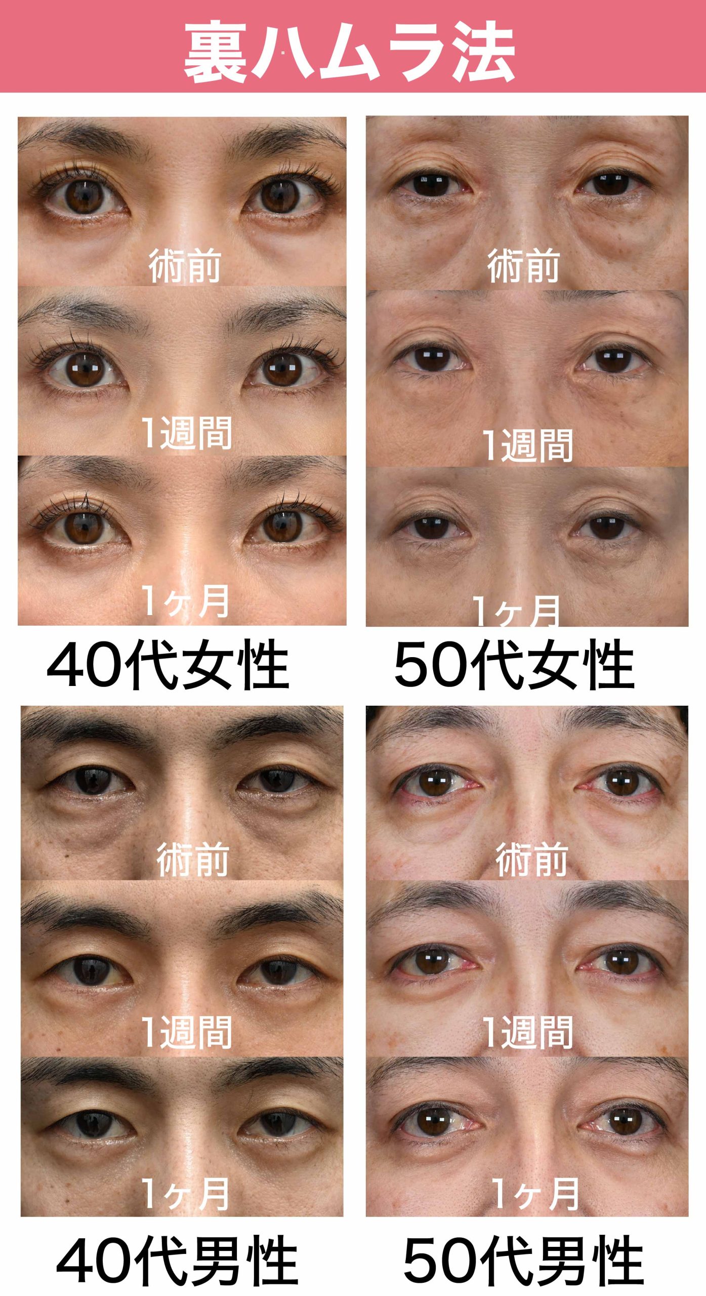 【裏ハムラ法】症例紹介