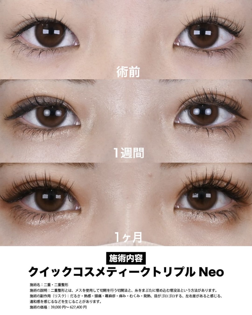 埋没法