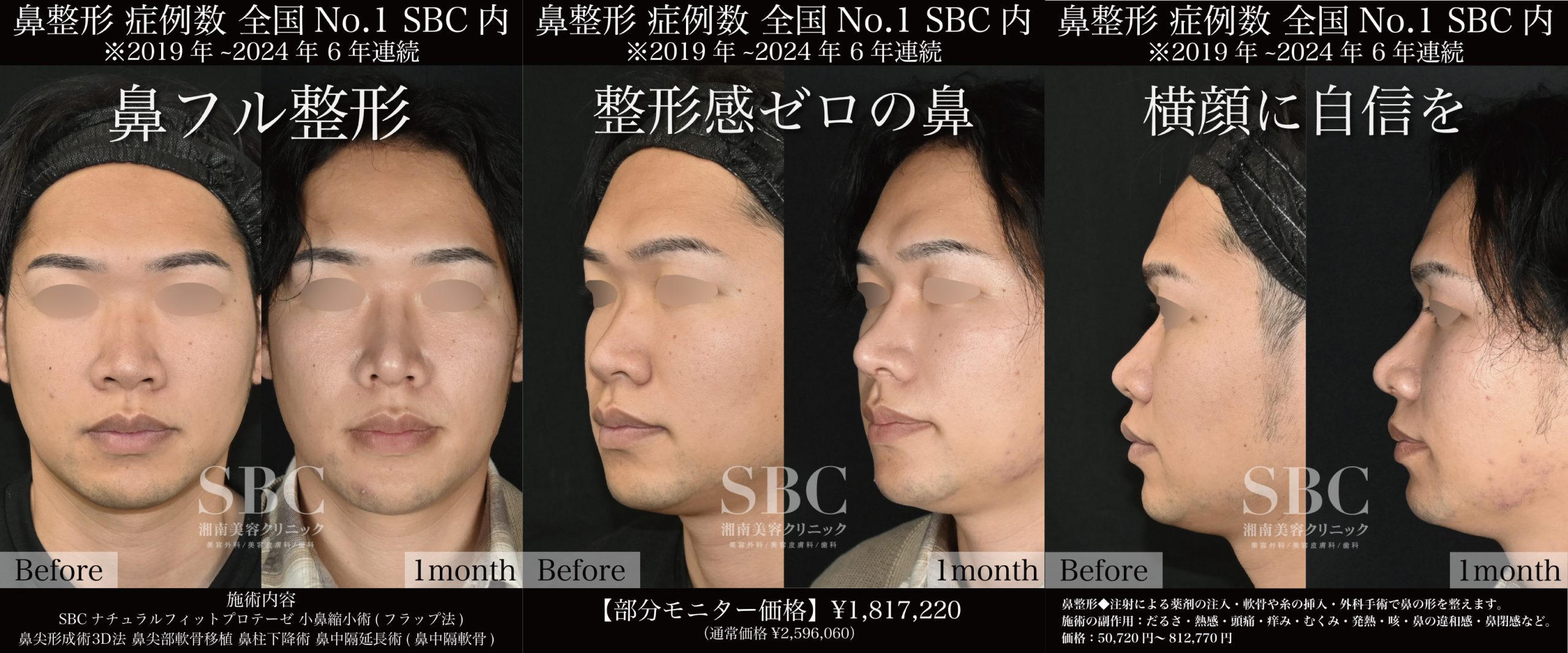鼻フルセットで整形感ゼロの鼻整形