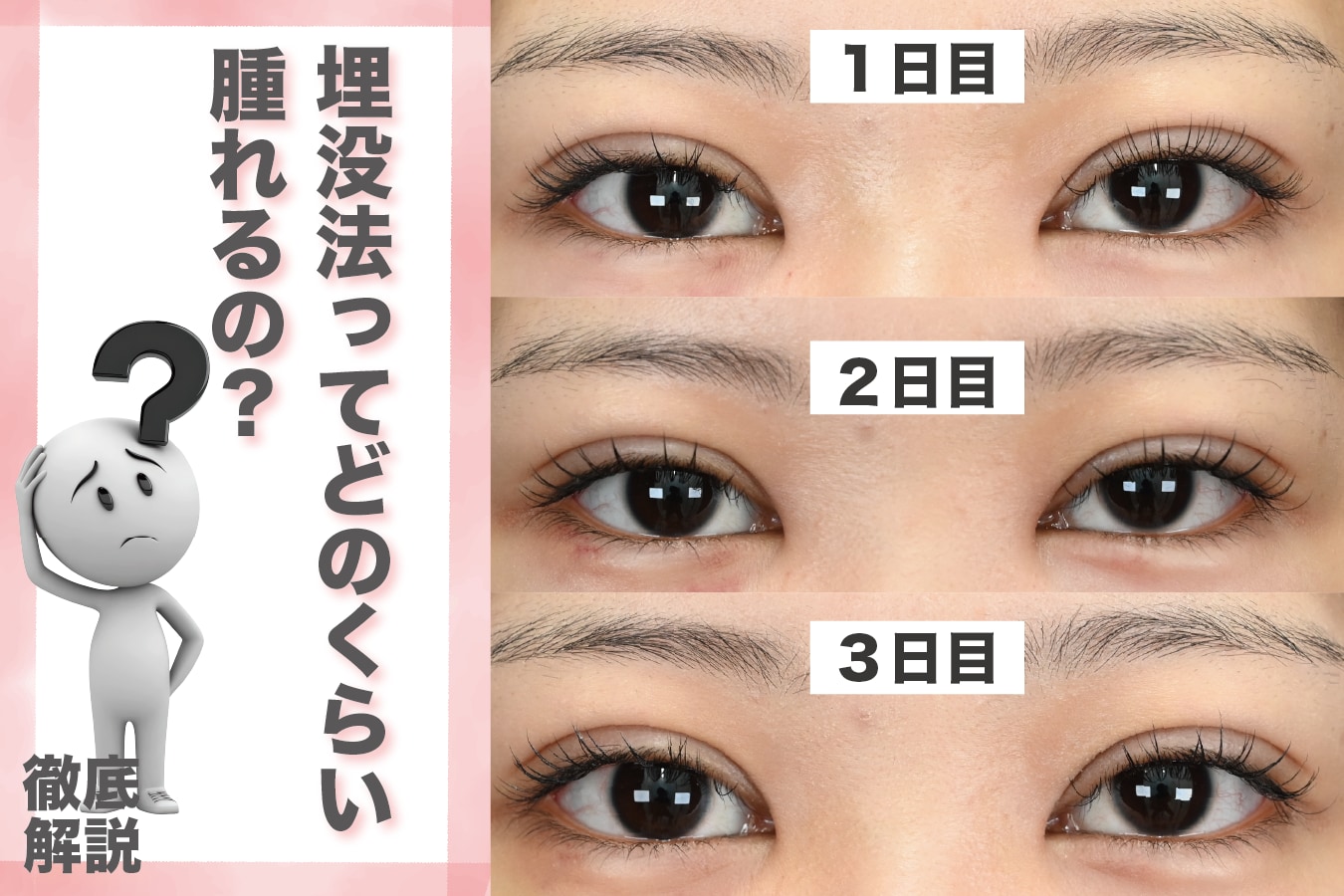 埋没法の腫れはどのくらい？ダウンタイムと過ごし方を徹底解説！