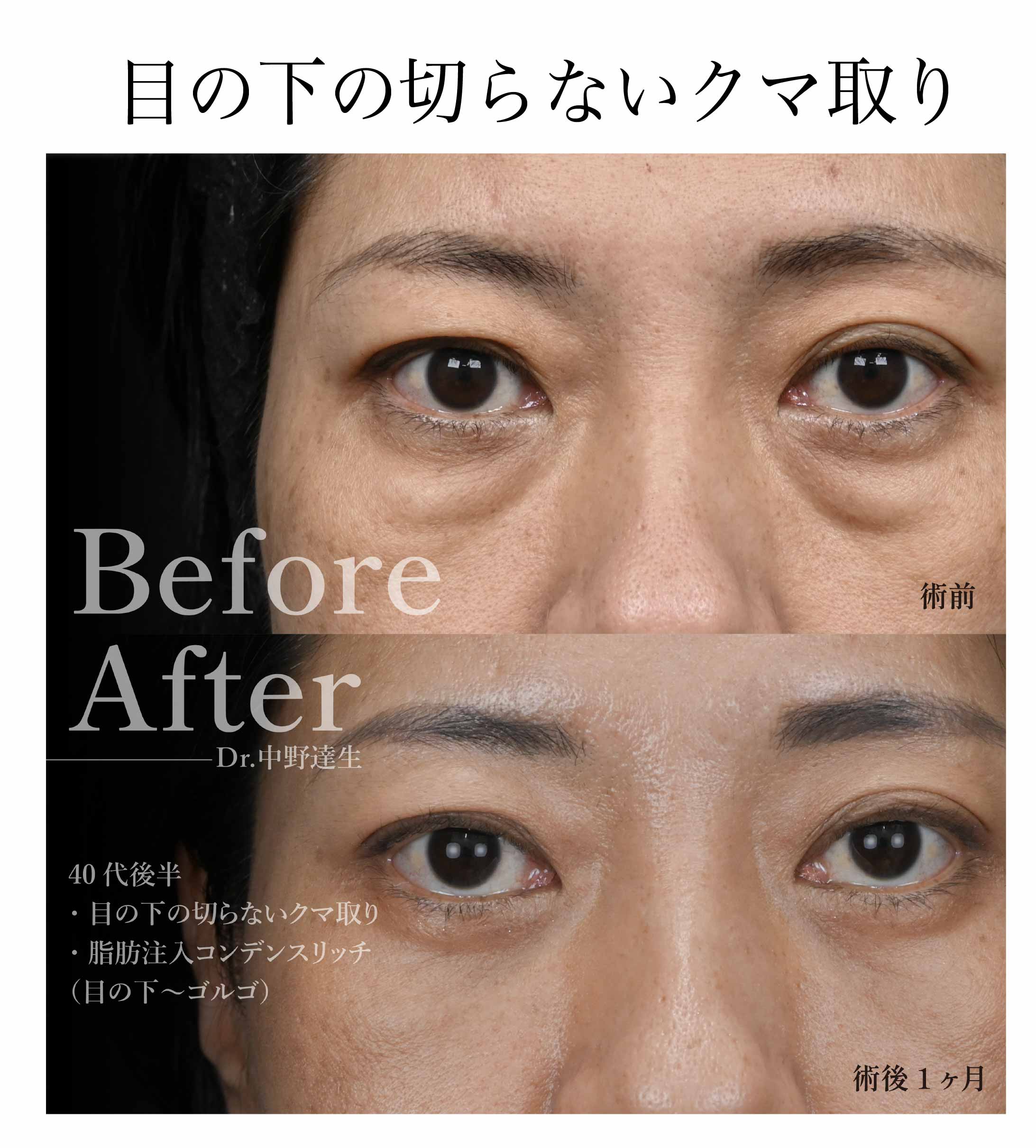 目の下の切らないクマ取り・たるみ取り(脱脂術)