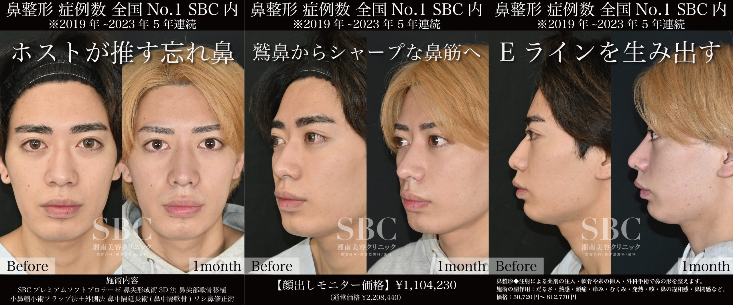 Eラインを生み出す鼻整形