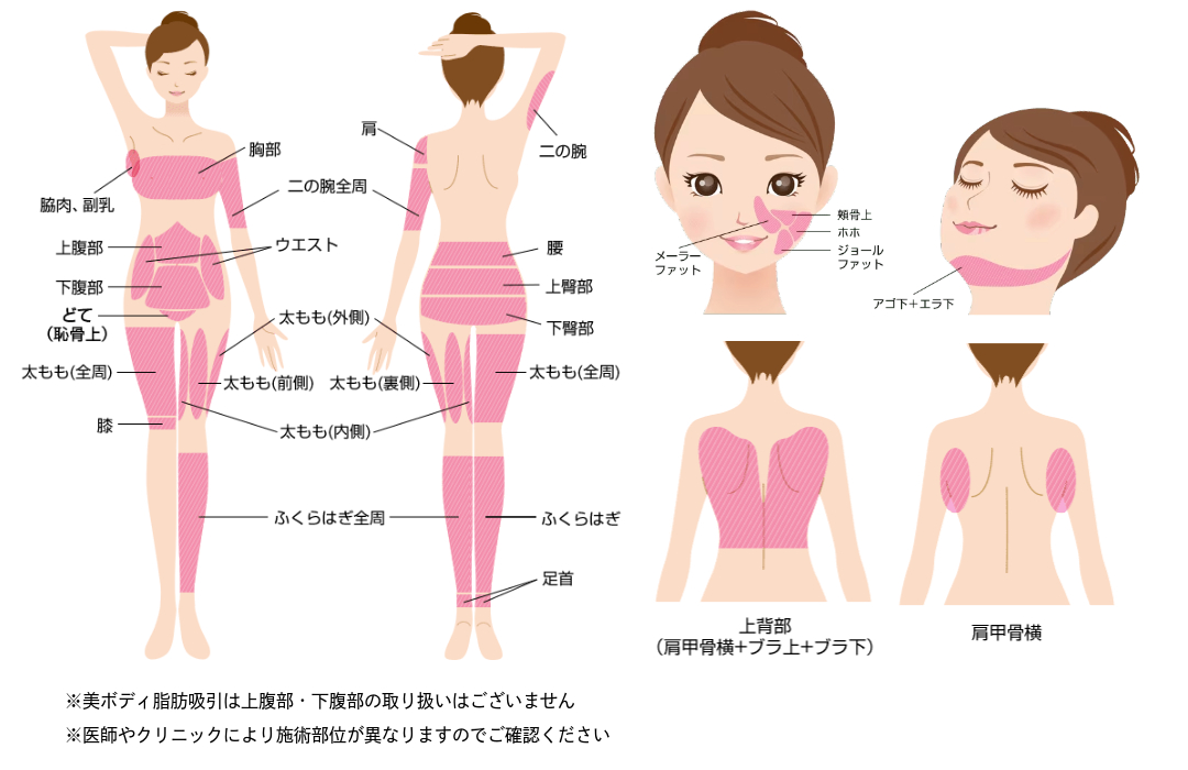 脂肪吸引できる部位はここ