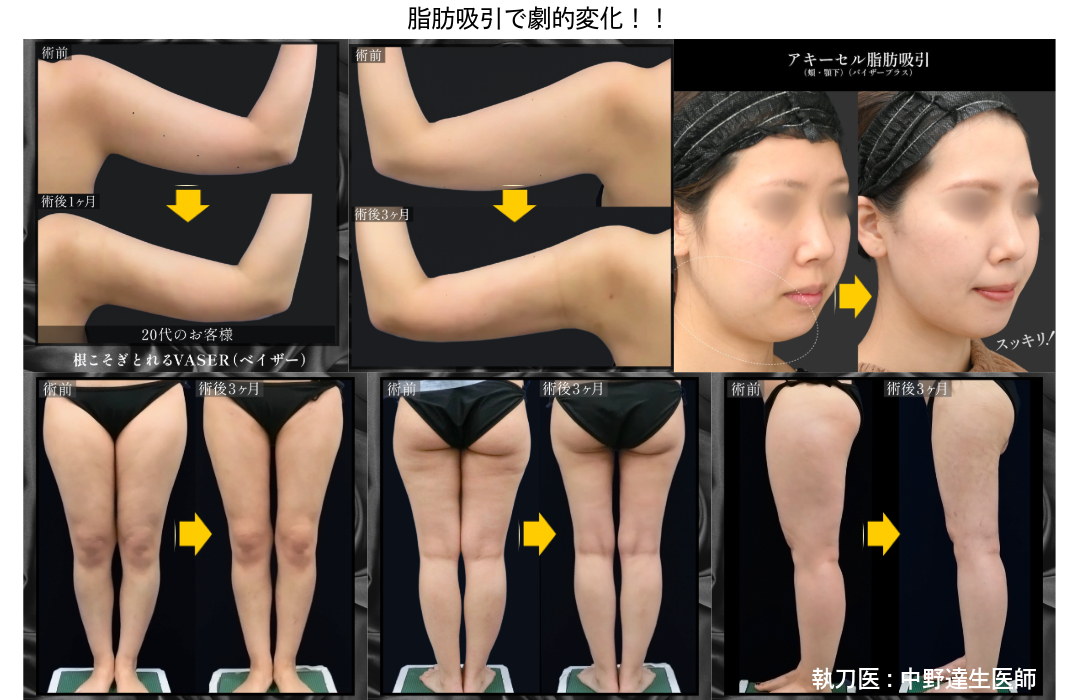 脂肪吸引をするとこのように変わります!