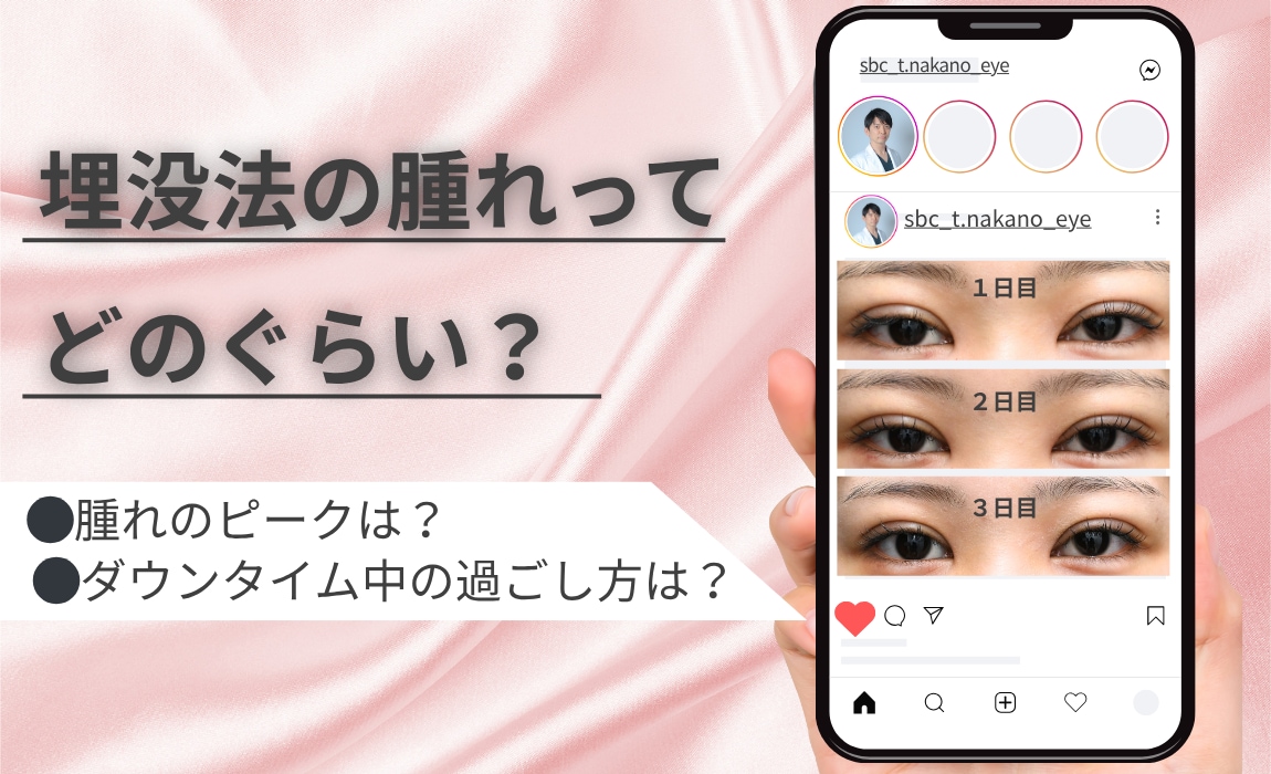 埋没法の腫れはどのくらい？ダウンタイムと過ごし方を徹底解説！