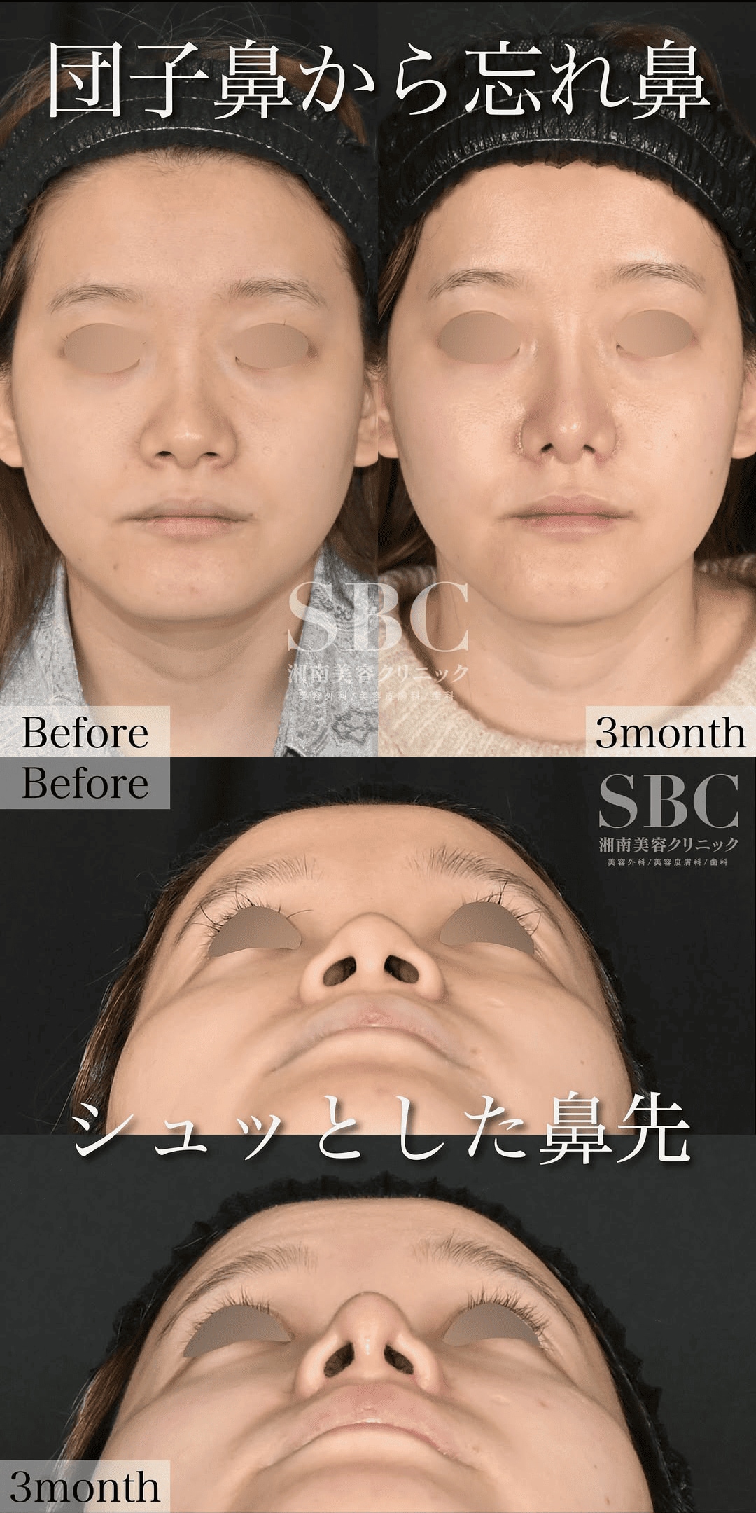 鼻尖、鼻筋、鼻翼をトータル的に整える鼻整形の総称です!