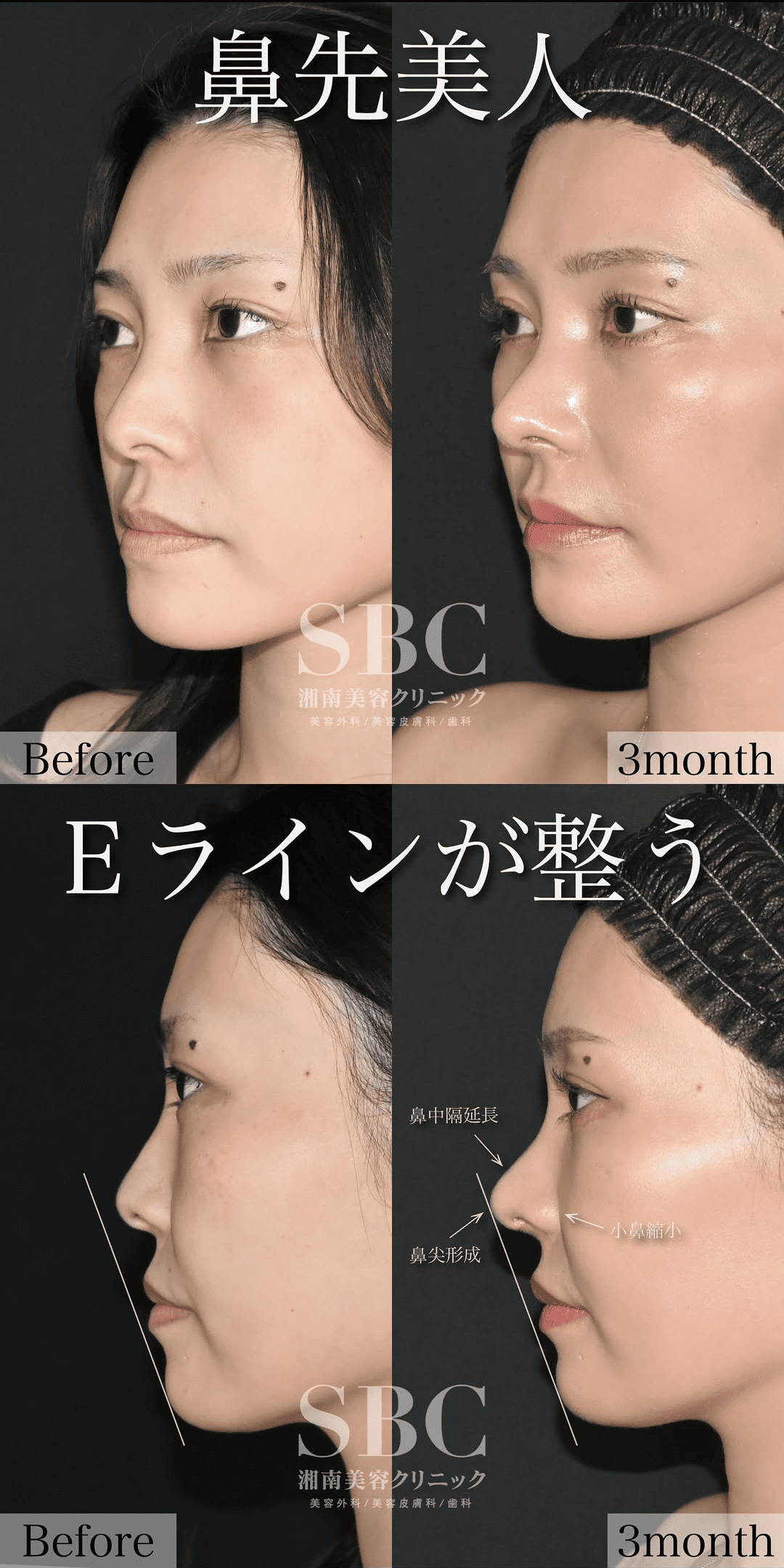 鼻フルセットに追加で他の鼻治療を加えられますか?
