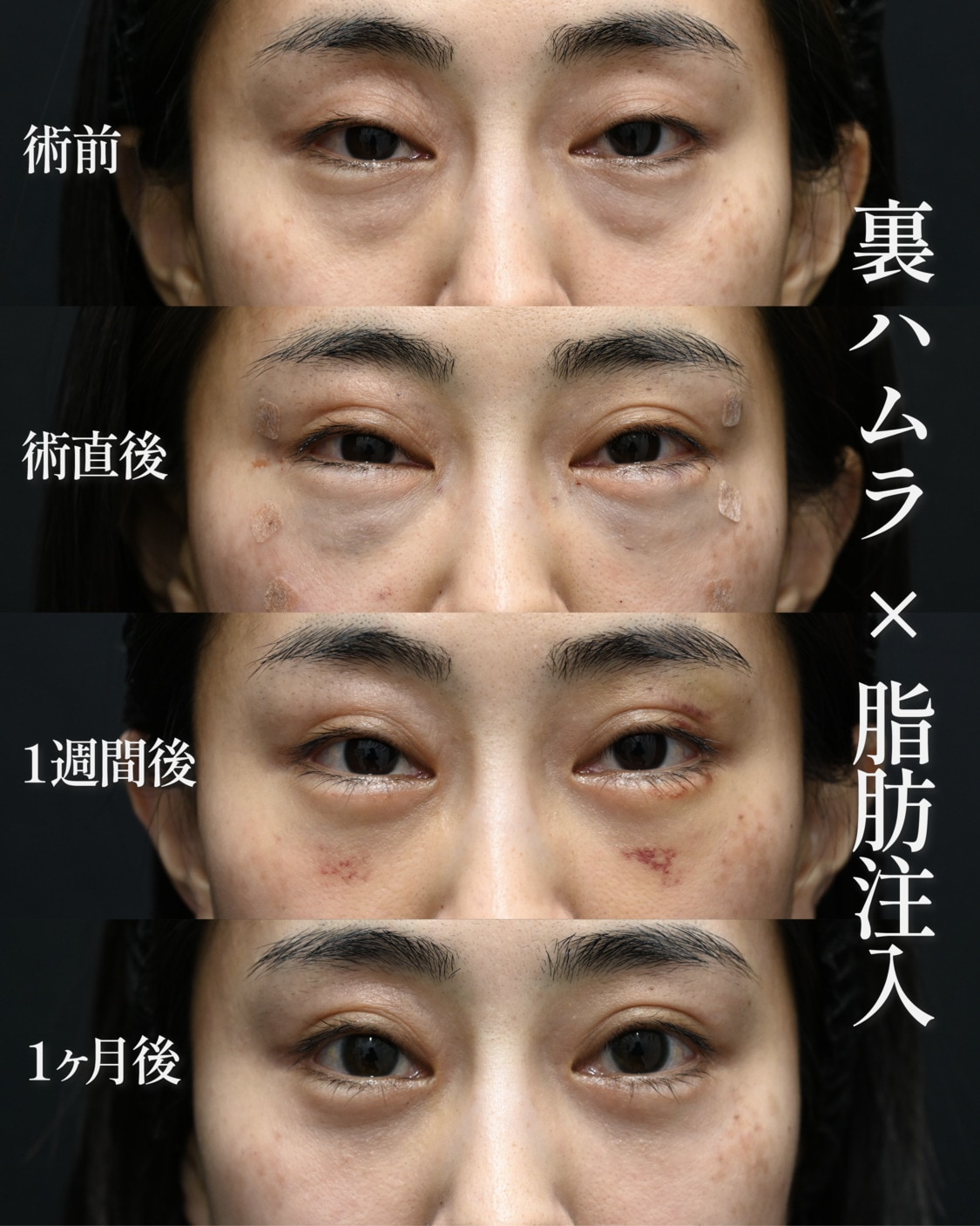 クマ取り治療の症例