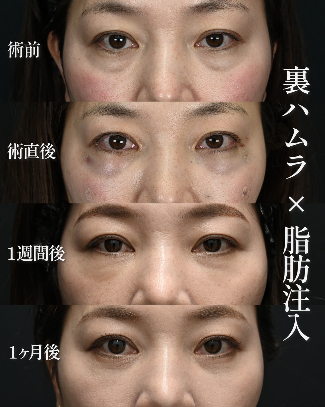 40代女性:インフルエンサー様の症例